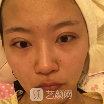卿勇双眼皮实例，漂亮眼眸拯救整张脸~