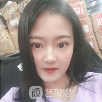 卿勇双眼皮实例，漂亮眼眸拯救整张脸~