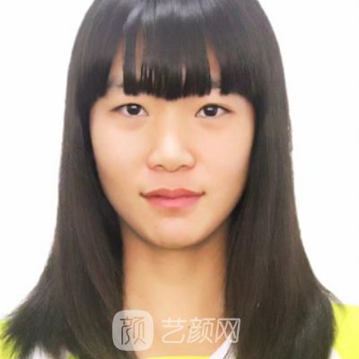 四川华美紫馨整形医院隆鼻实例曝光|附体验成果图