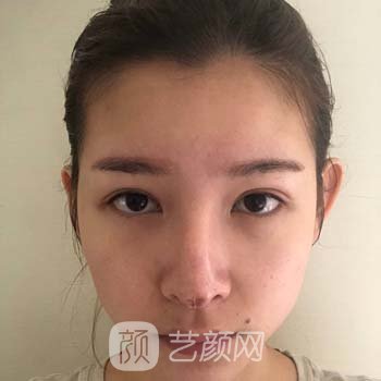 北医三院安阳隆鼻失败修复实例，术后打造宛若天生的鼻部形态