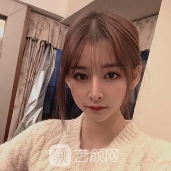 北医三院安阳隆鼻失败修复实例，术后打造宛若天生的鼻部形态