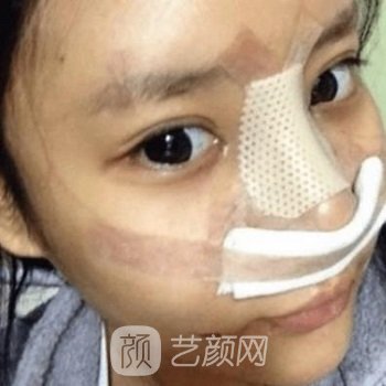 蒋翔峰隆鼻手术的实例，术后完成了美丽蜕变~
