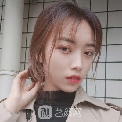 北京睐美安整形医院割双眼皮怎么样?2023体验实例展示