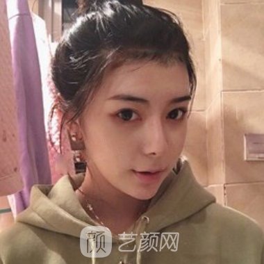 广州青逸植发怎么样?成果可靠吗?全新头发加密实例曝光