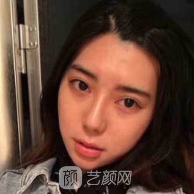 广州青逸植发怎么样?成果可靠吗?全新头发加密实例曝光