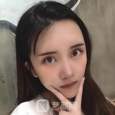 长春铭医李红做双眼皮怎么样?90天修复实例分享
