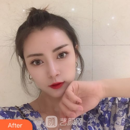 无锡瑞丽整形医院瘦脸除皱实例展示｜附成果对比图