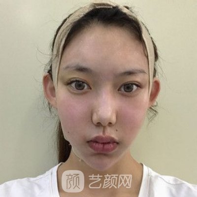上海李湘原做下颌角技术怎么样？医生实力及实例公开