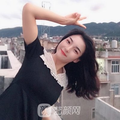 浙江省中医院整形科隆鼻成果怎么样？亲身体验实例曝光