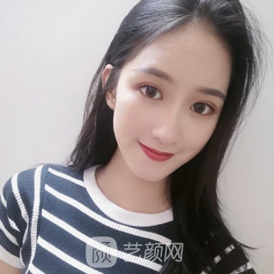 乐山人民医院整形科做双眼皮怎么样？全新招牌实例公开