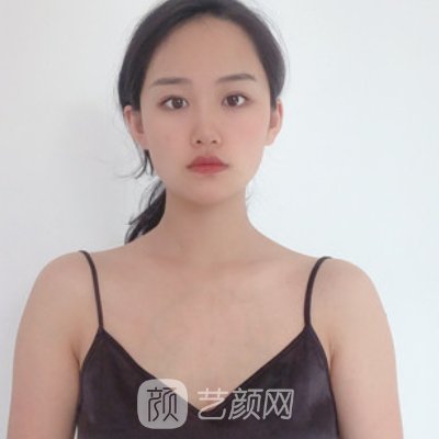 上海伊莱美隆胸技术展示｜2023崭新实例一览