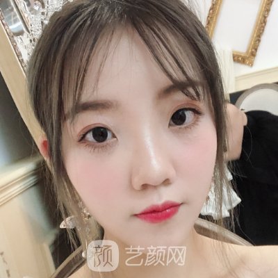 成都叶斌医生磨骨实例展示｜成果自然美观