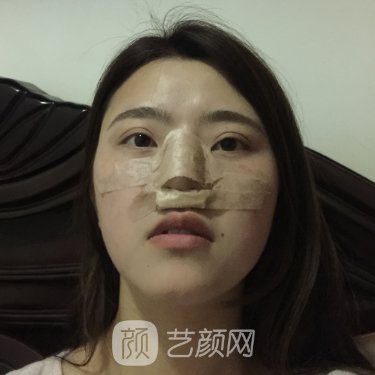 广州荔湾人民医院整形科隆鼻实例曝光｜成果自然美观