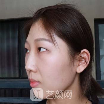 襄阳悦美割双眼皮怎么样？医生名单+双眼皮整形实例