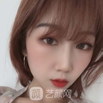 襄阳悦美割双眼皮怎么样？医生名单+双眼皮整形实例