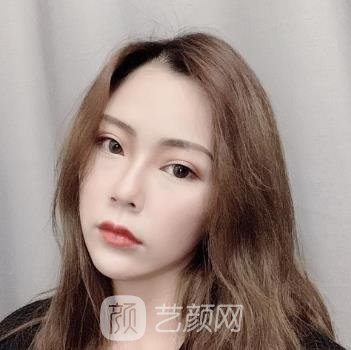 长春中妍整形医院怎么样？人气医生介绍+双眼皮整形实例
