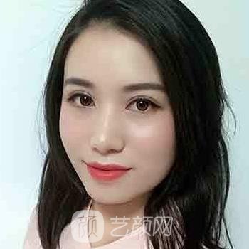 陆军总院刘萍双眼皮实例，术后眼睛明媚迷人，没有手术痕迹