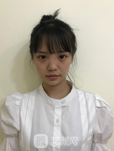 闫宏山隆鼻实例，术后拍照也很上镜哦~