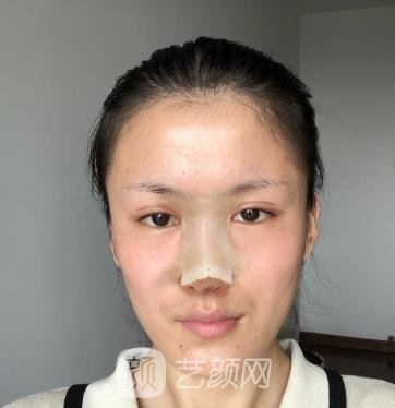 重庆张恒术隆鼻实例，变美这件事情真是好让人开心