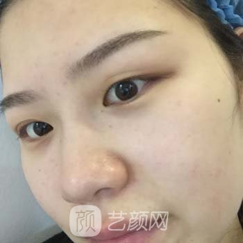 北医三院薛红宇双眼皮实例，一下子就从丑小鸭变成了白天鹅