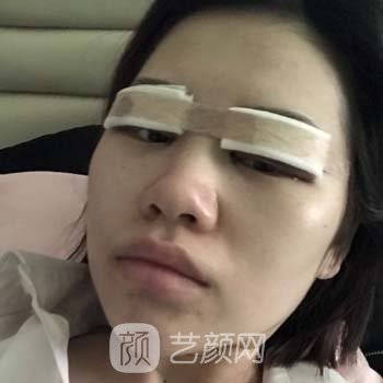 北医三院薛红宇双眼皮实例，一下子就从丑小鸭变成了白天鹅