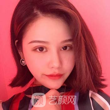 北医三院薛红宇双眼皮实例，一下子就从丑小鸭变成了白天鹅