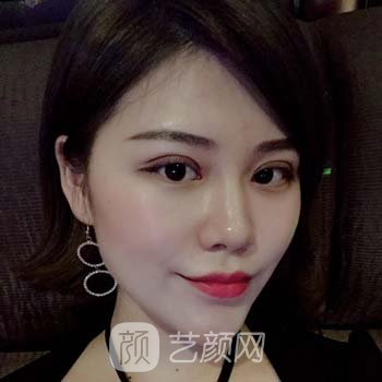 北医三院薛红宇双眼皮实例，一下子就从丑小鸭变成了白天鹅