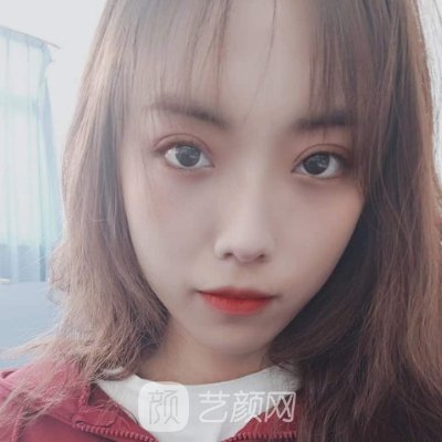 上海美立方整形医院口碑怎么样?崭新双眼皮体验实例一览