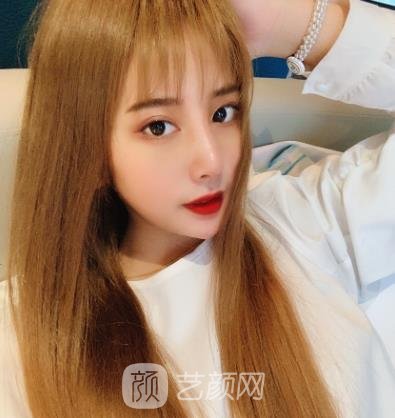 戴传昌隆鼻修复手术实例，形态精致好看，和之前形成了鲜明的对比