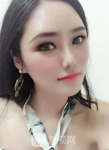 邵文辉隆鼻失败修复实例，术后线条感特别理想~