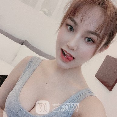 武汉美莱整形医院隆胸实例公开|2023体验成果图展示