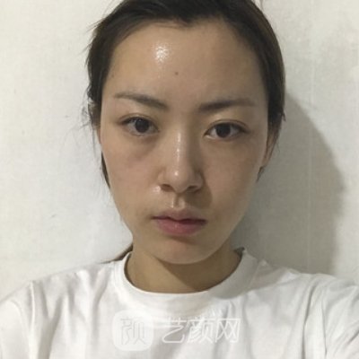 湘潭市中心医院美容科隆鼻咋样?2023全新体验实例出炉