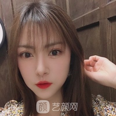 湘潭市中心医院美容科隆鼻咋样?2023全新体验实例出炉