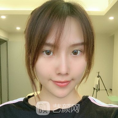 武汉仁爱时光医疗美容医院隆鼻实例出炉|成果自然美观