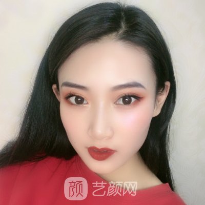 杭州冠美整形医院割双眼皮怎么样?90天体验实例公开