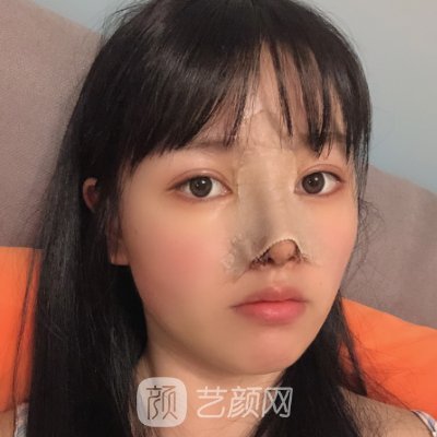 杭州赫本整形医院隆鼻实例出炉|成果自然无痕