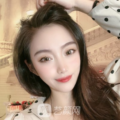 河南省人民医院整形科双眼皮实例展示|成果自然无痕