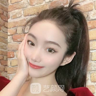 河南省人民医院整形科双眼皮实例展示|成果自然无痕