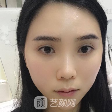济宁韩美整形医院隆鼻技术怎么样?全新体验实例集中一览