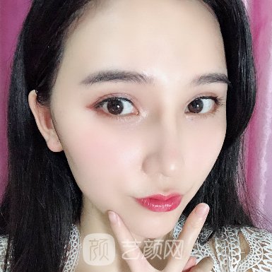 济宁韩美整形医院隆鼻技术怎么样?全新体验实例集中一览