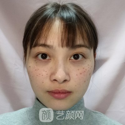 南海人民医院全新点阵激光实例公开|附体验成果图