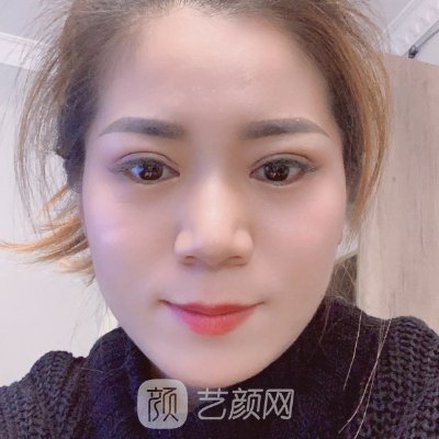 沈阳协和医院双眼皮整形成果怎么样?2023招牌阿里发布