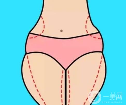 吸脂需要制定详细的计划吗？需要做几次？