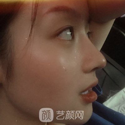 南昌亚太新版隆鼻实例公开|内附体验成果图