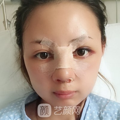 西安交大一附院整形科怎么样?全新隆鼻实例分享