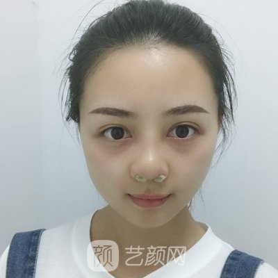 西安交大一附院整形科怎么样?全新隆鼻实例分享