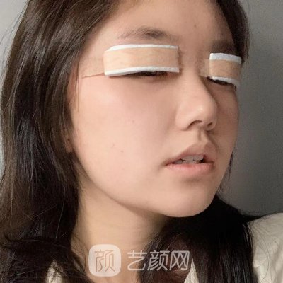 哈尔滨艺星整形医院怎么样?2023双眼皮整形实例分享