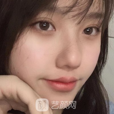 哈尔滨艺星整形医院怎么样?2023双眼皮整形实例分享