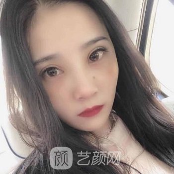 合肥孔亚男隆鼻实例，从侧面看倾斜度特别好看，美美哒
