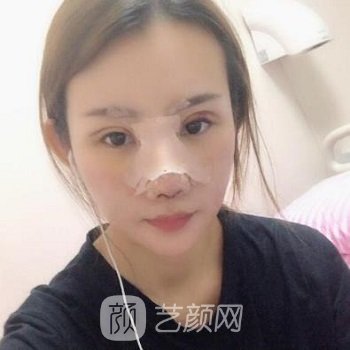 程勇隆鼻实例，打造天生的妈生鼻，面部轮廓也立体